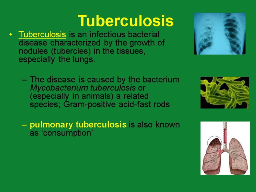 Tuberculosis Tuberculosis is an infectious bacterial disease characterized by the growth of nodules (tubercles)